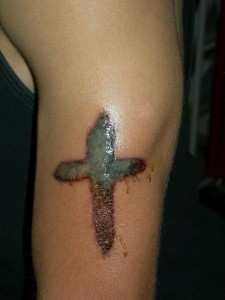 200726320530 Tattoo Infection